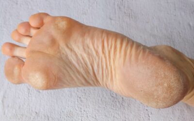 How Swift Therapy Helps Treat Those Stubborn Plantar Warts on Your Feet