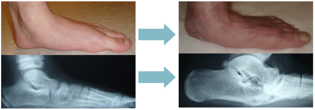 Flatfoot Correction Xray