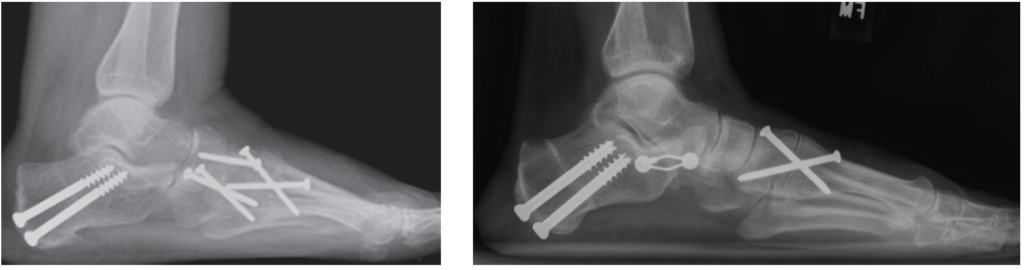 HyProCure Post Op Reconstruction Xray