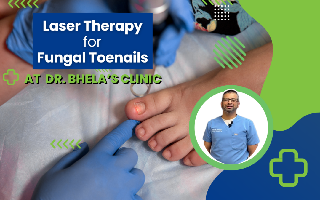 Laser Therapy for Fungal Toenails