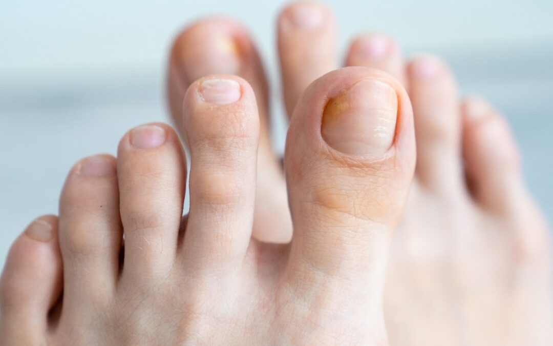 Innovative Treatment for Toenail Fungus with Laser Therapy