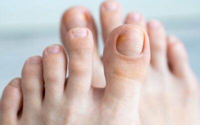 Innovative Treatment for Toenail Fungus with Laser Therapy