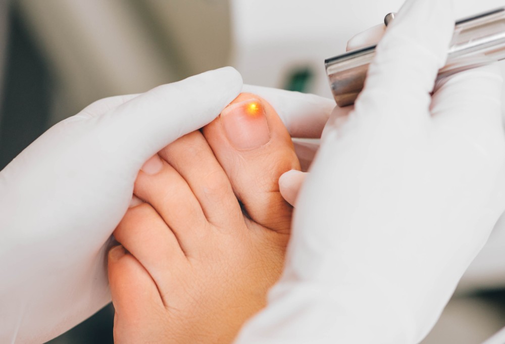 Laser therapy treating fungal toenails