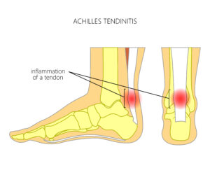 Laser therapy treating fungal toenails