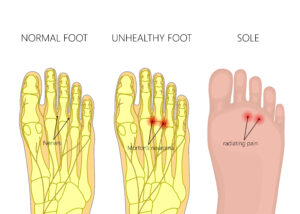 Laser therapy treating fungal toenails