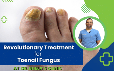 Revolutionary Treatment for Toenail Fungus at Dr. Bhela’s Clinic