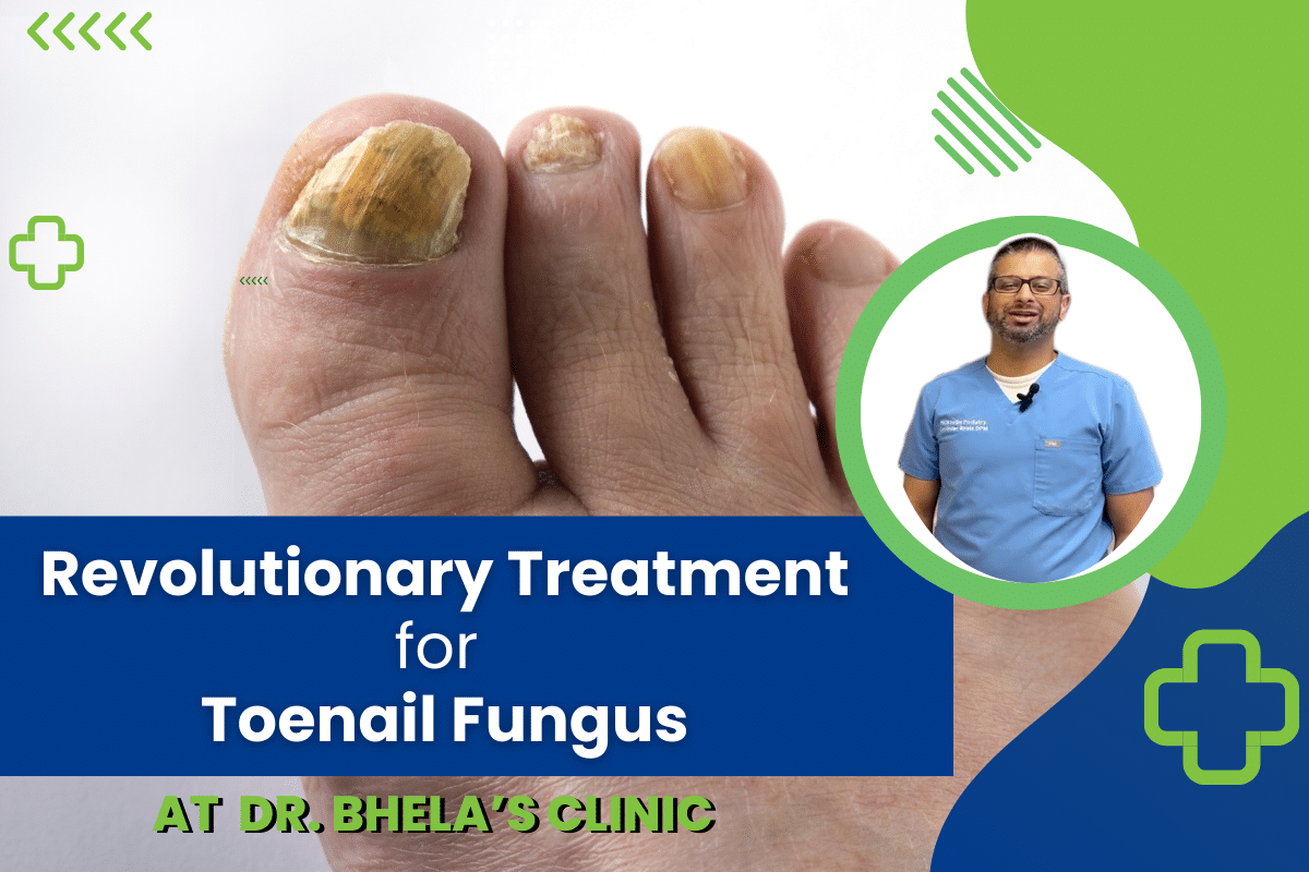 Revolutionary Treatment for Toenail Fungus at Dr. Bhela’s Clinic