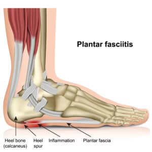 Laser therapy treating fungal toenails