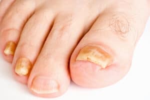 Laser therapy treating fungal toenails