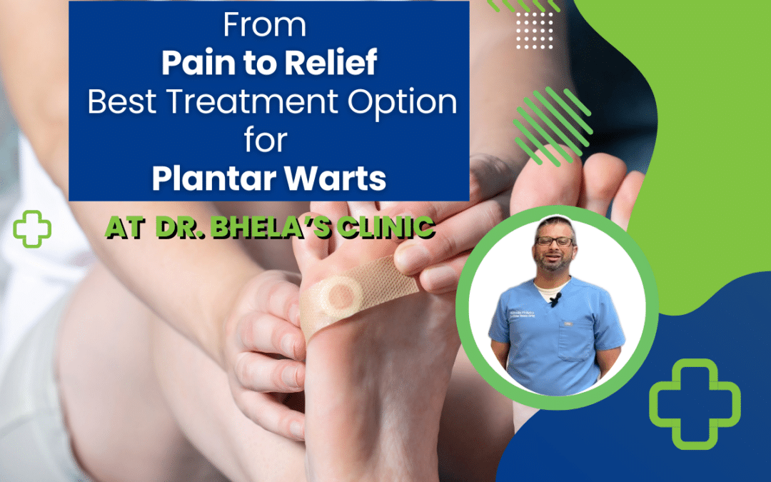 From Pain to Relief: Best Treatment Option for Plantar Warts