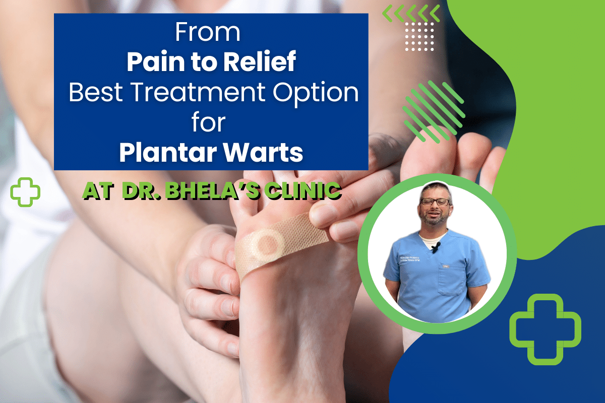 From Pain to Relief: Best Treatment Option for Plantar Warts