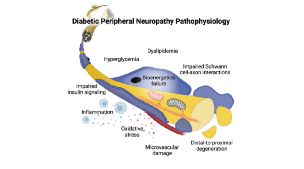 Diagram of diabetic peripheral neuropathy pathophysiology