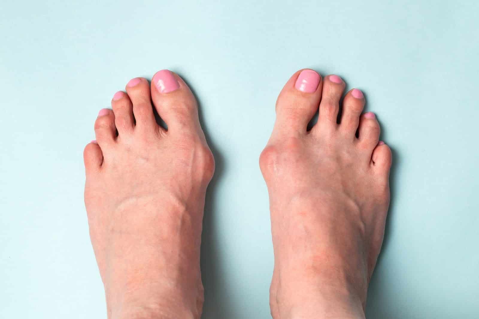 Reasons to Avoid Wearing Heels Daily-foot bunions