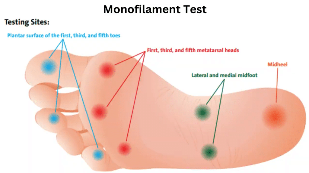 A picture of testing sites on a feet for monofilament test 