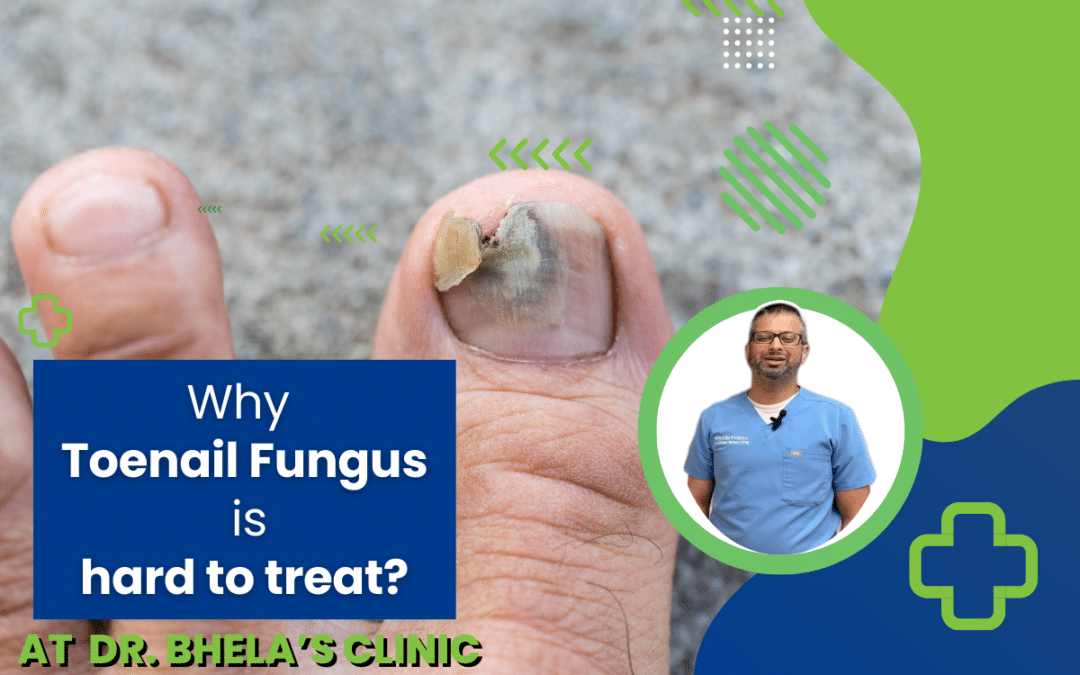 Why Toenail Fungus is Hard To Treat?