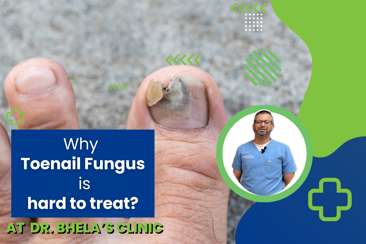 Why Toenail Fungus is Hard To Treat