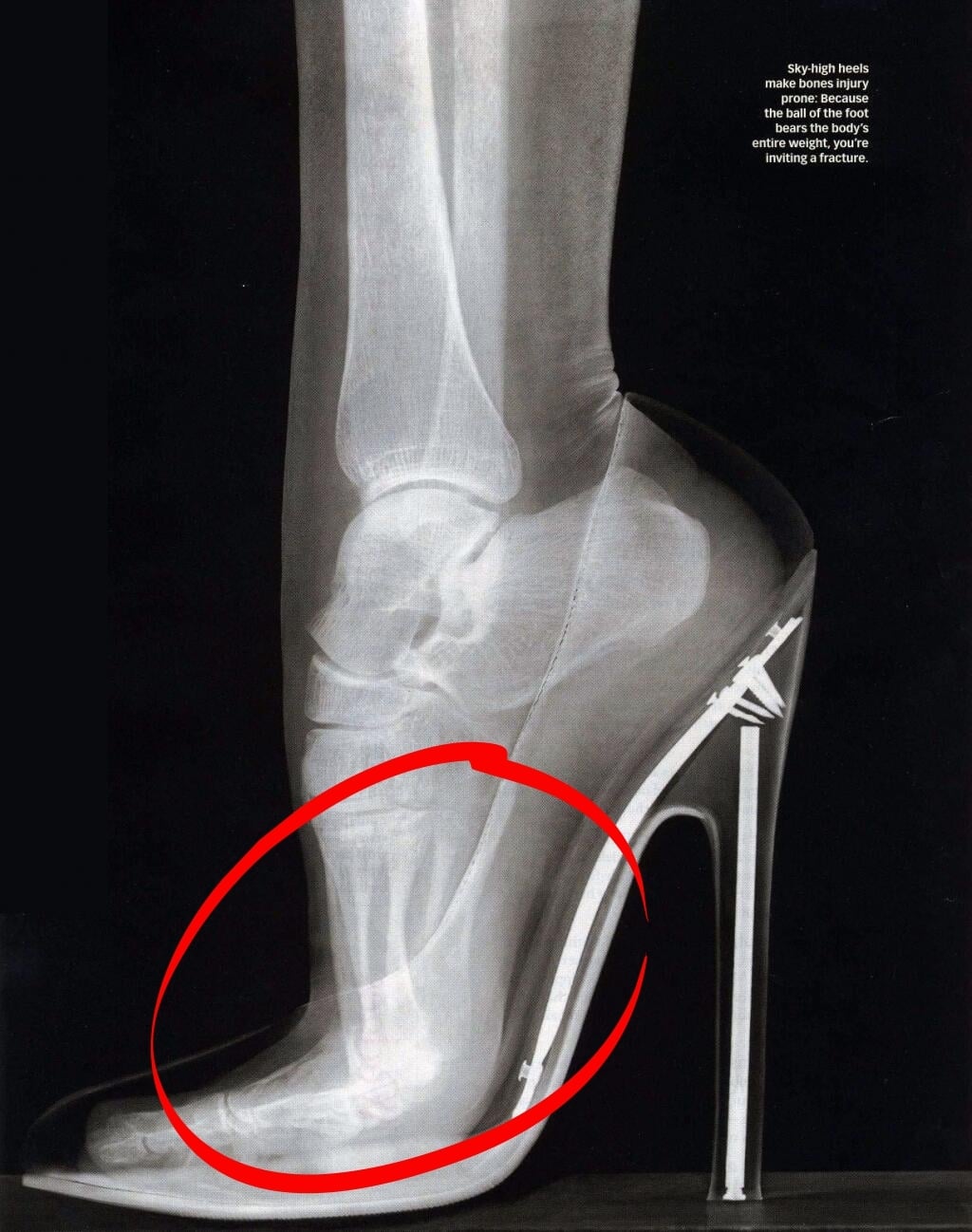 X-ray showing pressure points on the foot