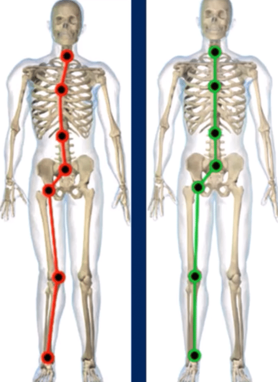 A diagram of normal foot and foot with misalignment