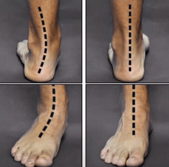 A picture of Different Alignment In Legs