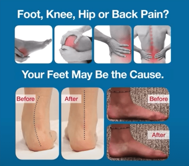 Before and after heel pronation