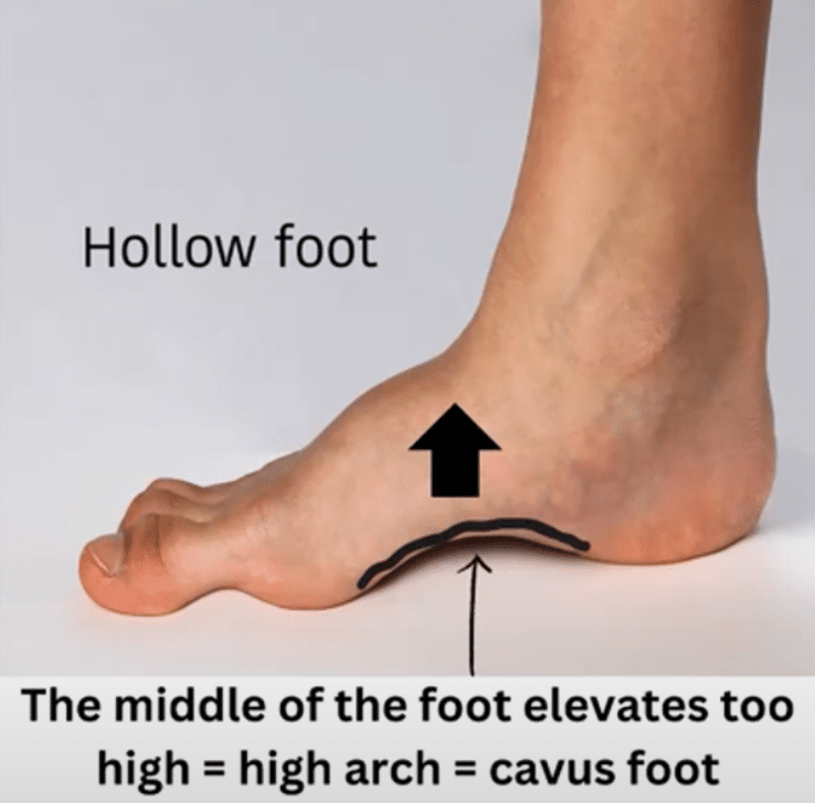 Cavus Foot Structure