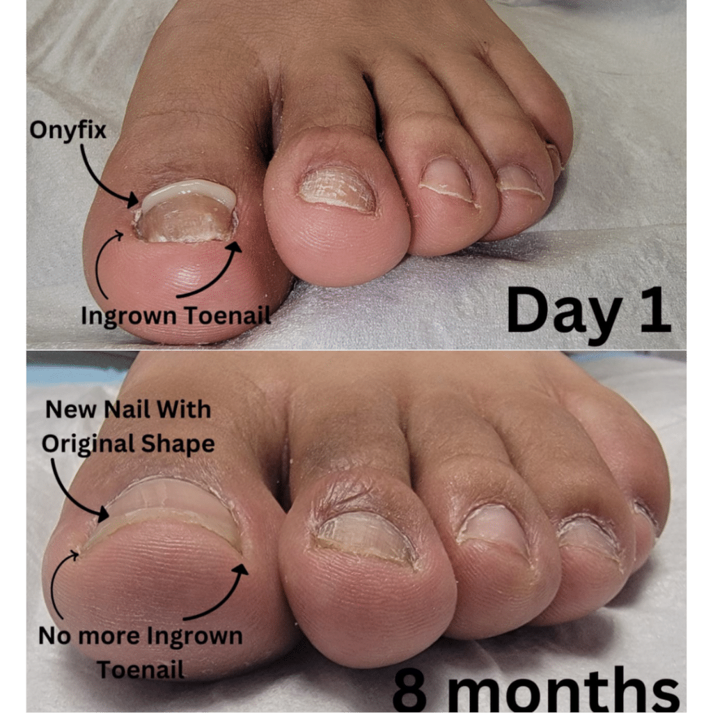 Comparison image showing the before and after Onyfix treatment of an ingrown toenail.