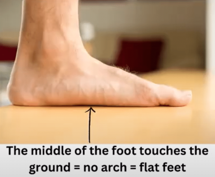 Flatfoot Structure