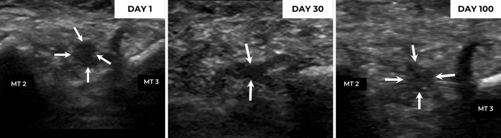 Laser Treatment For Foot Neuroma at Restore Podiatry