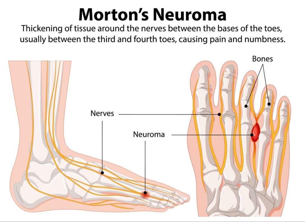 Picture of Morton's neuroma