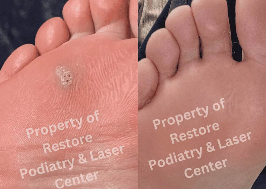 A stubborn plantar wart of 2 years before and after Swift Microwave Therapy at Restore Podiatry