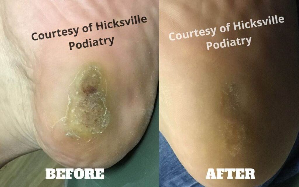 A stubborn plantar wart of 5 years before and after Swift Microwave Therapy