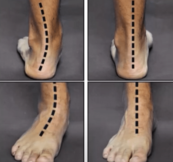 A-picture-of-Different-Alignment-In-Legs-e1727375630962-585x551