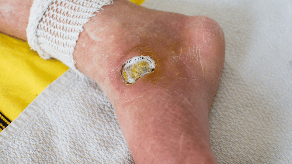 Diabetic Wound Care