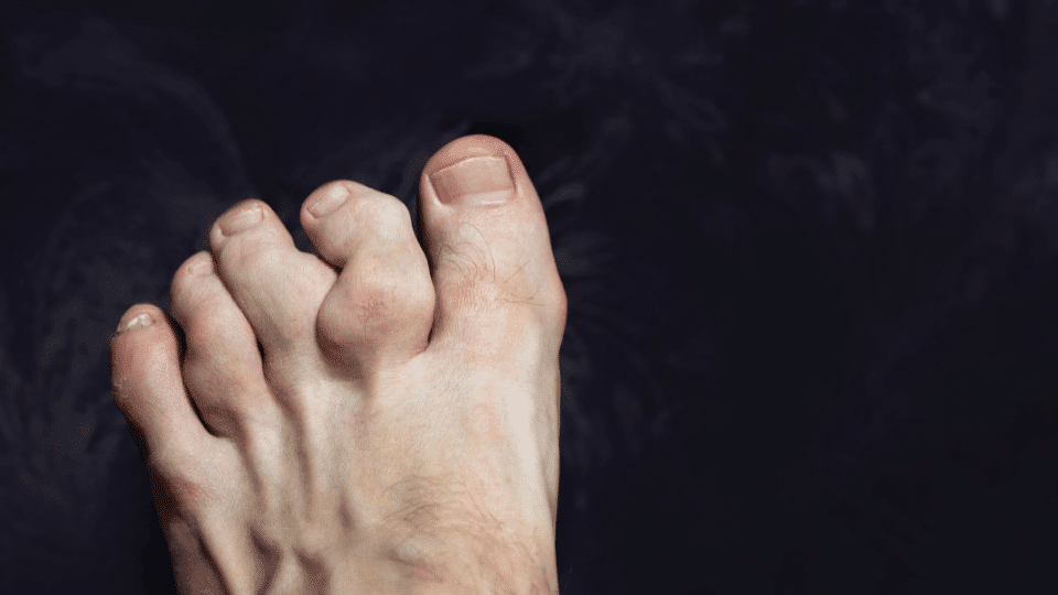 Hammertoe: Symptoms and Treatment Options