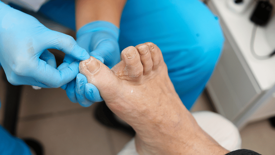 Ingrown Toenails: Treatment Options