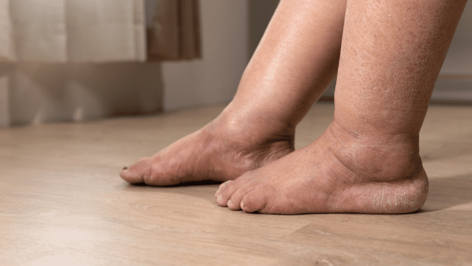 Symptoms of Foot Osteoarthritis