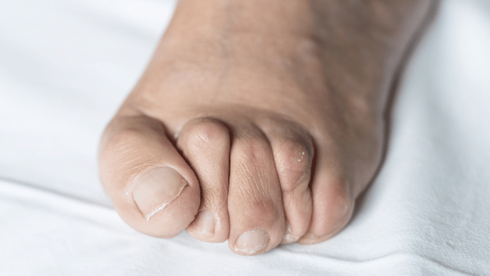 Symptoms of Hammertoe