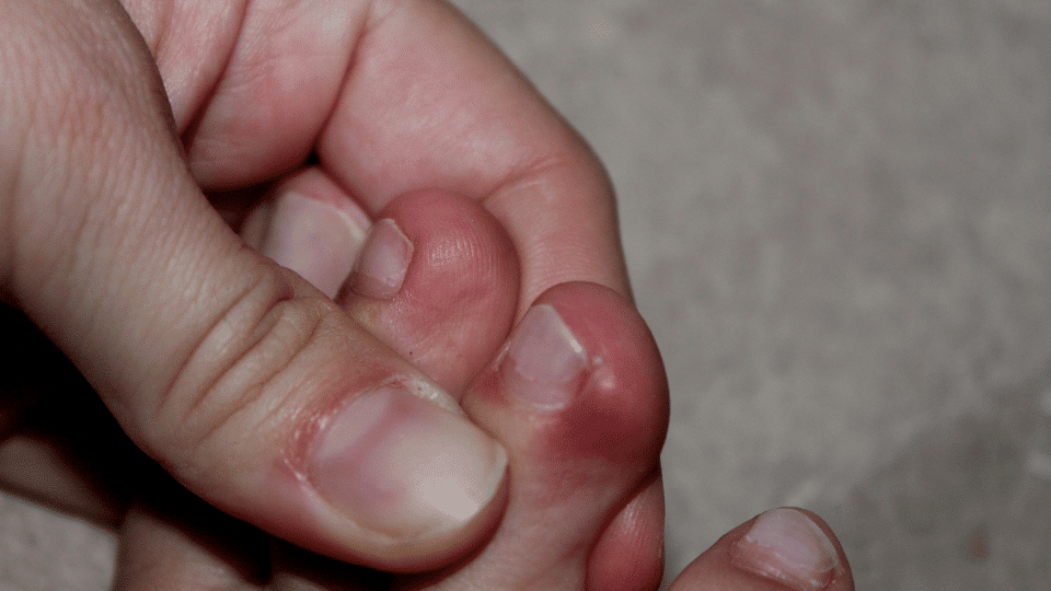 Symptoms of Ingrown Toenails