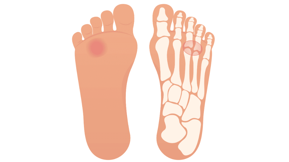 Symptoms of Neuroma