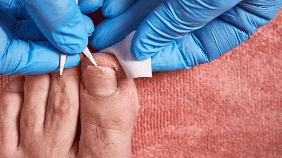 Toenail Fungus Treatment Options at Restore Podiatry