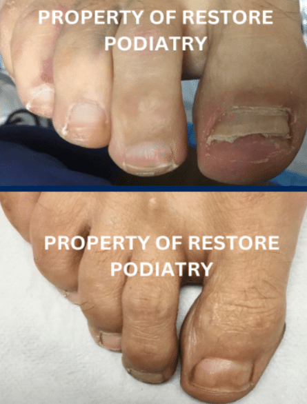 Before & After-images toenail fungus treatment