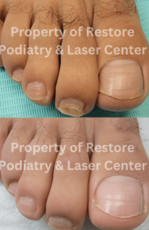 Before & After-images toenail fungus