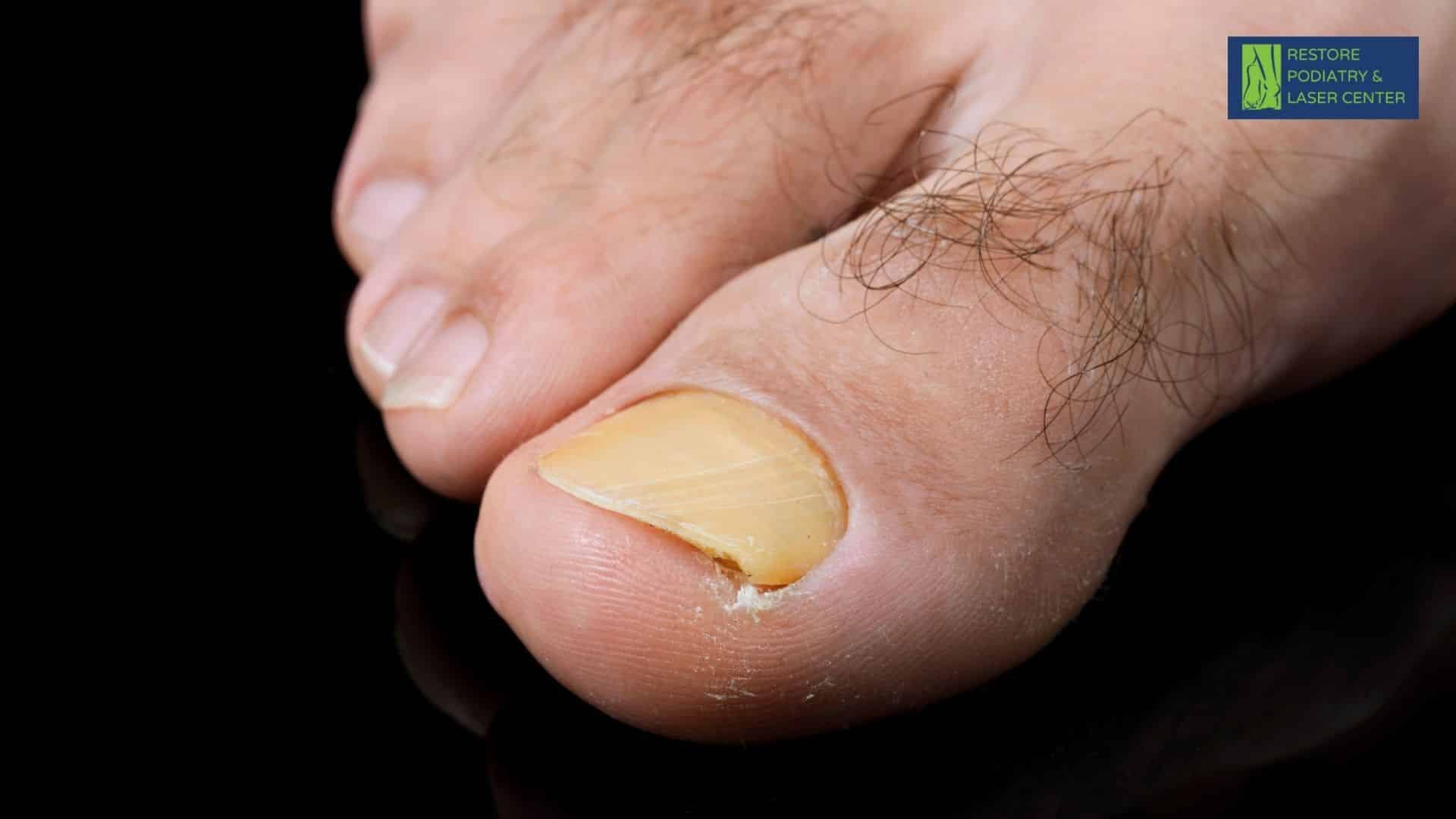 How To Avoid Toenail Fungus for Athletes