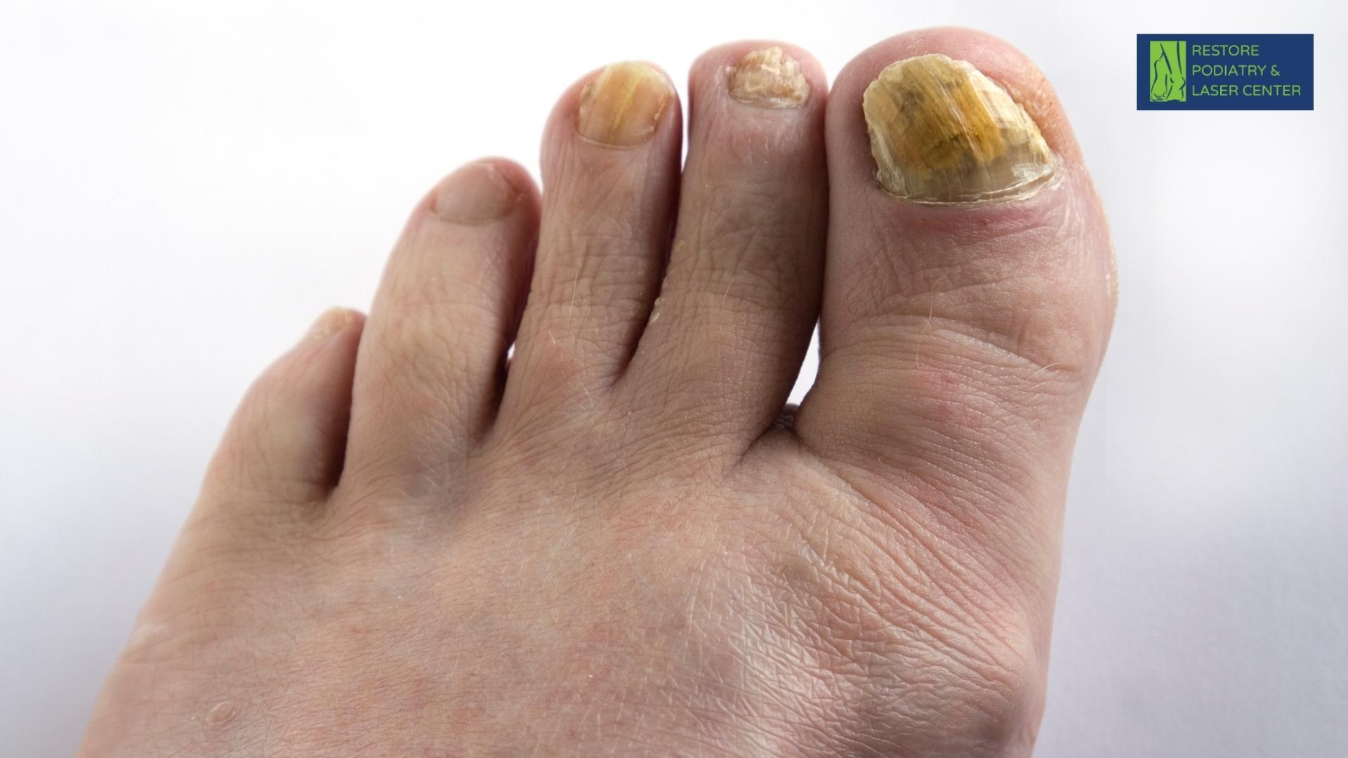 Repetitive Trauma toenail