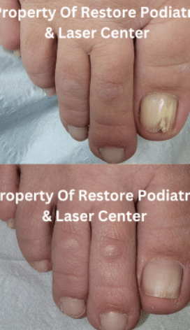 Restore Podiatry-toenail fungus treatment