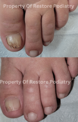 Restore Podiatry-toenail fungus