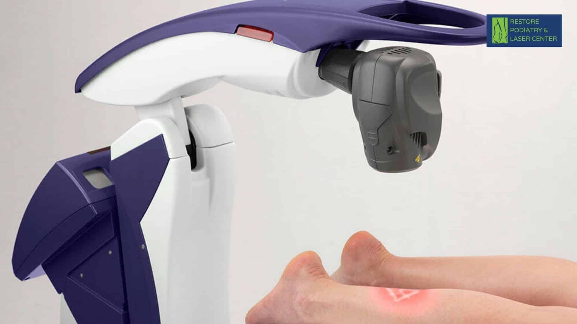 Nd YAG Laser Therapy (2)