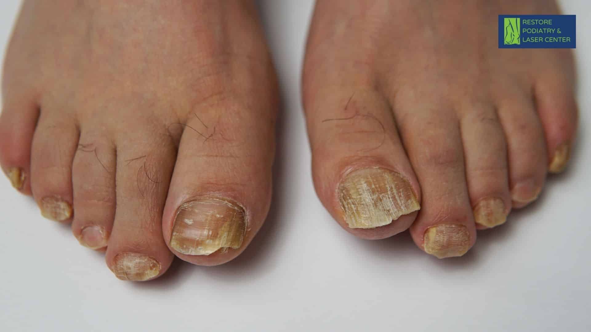 Toenail Fungus Treatment