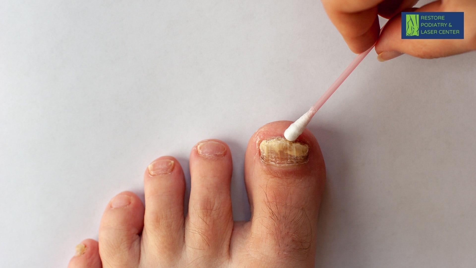 What is Toenail Fungus