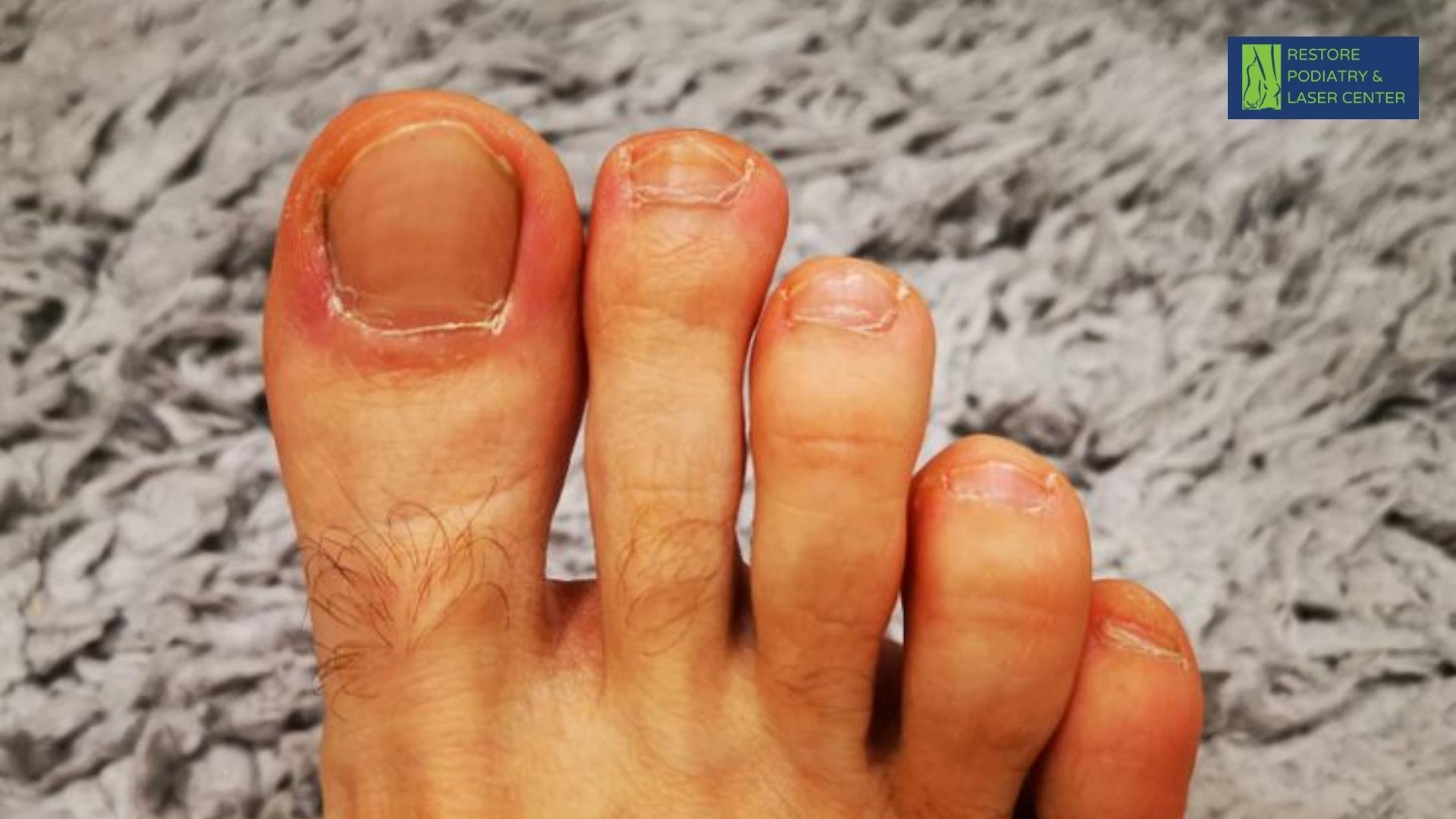 Eczema and Dermatitis toenails